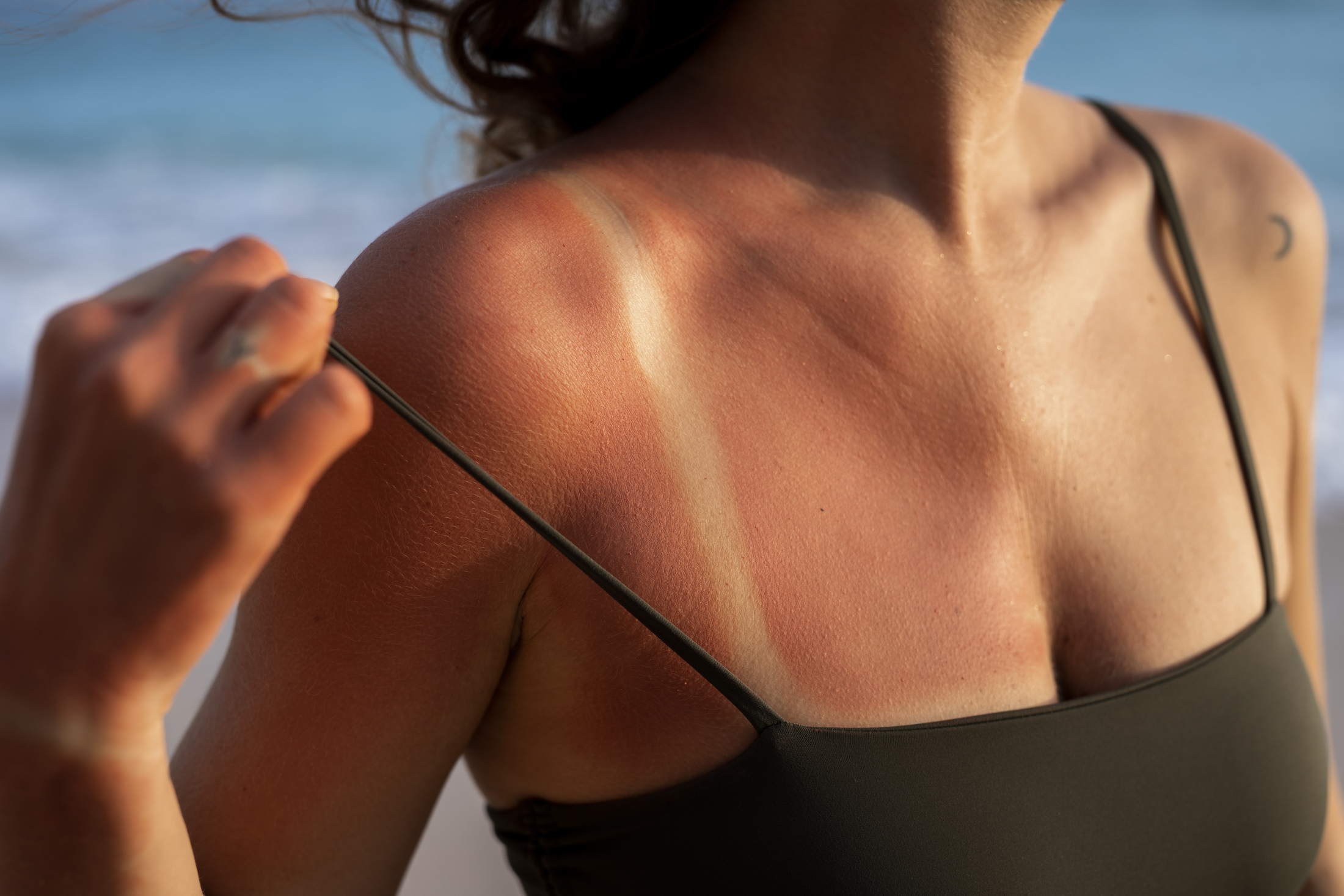 details-woman-s-sunburn-skin-from-beach-sun.jpg